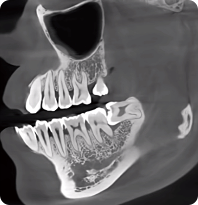 Low Dose Image with Algorithm