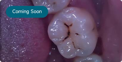 Intraoral Camera Images