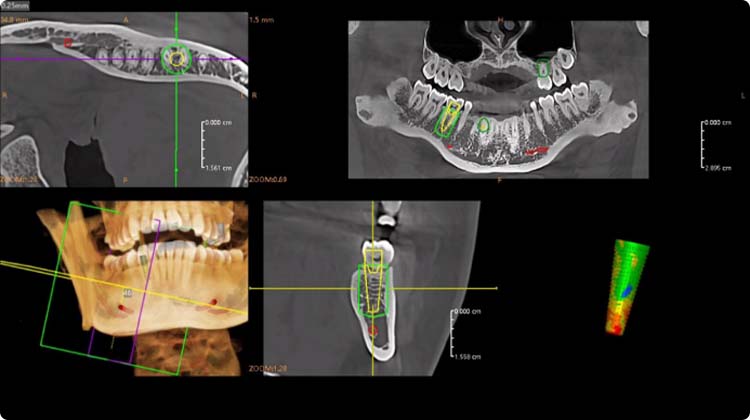 One-stop Implant Simulation