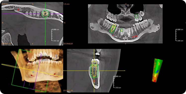 One-stop Implant Simulation