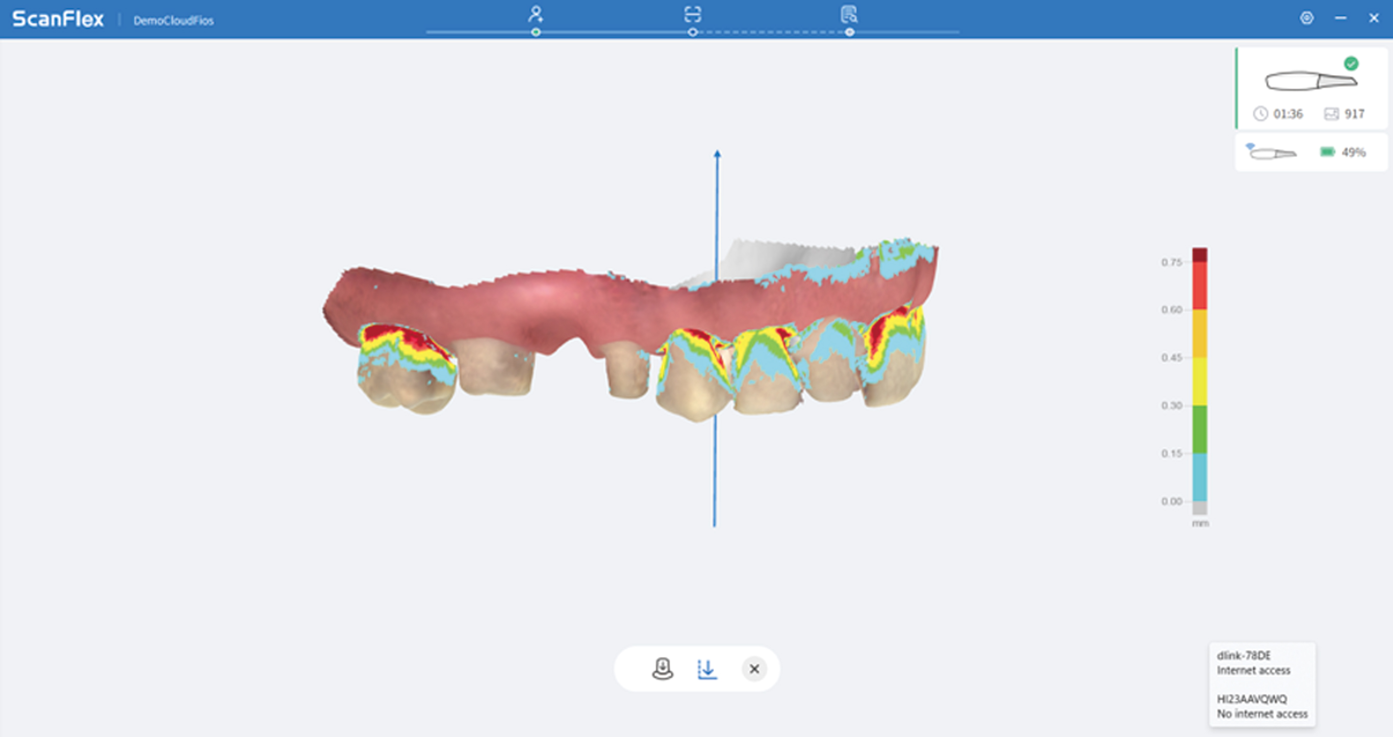 Undercut Analysis