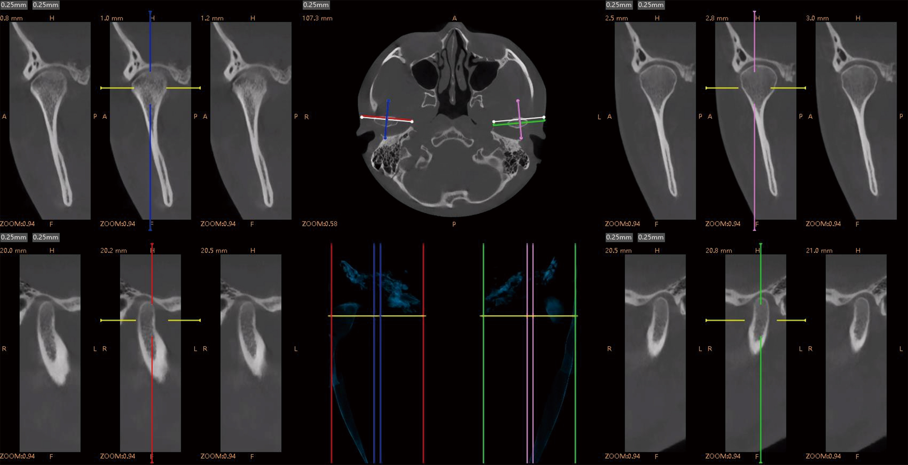 TMJ Diagnosis