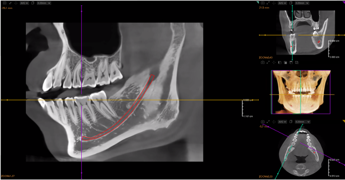 AI Inferior Alveolar Nerve