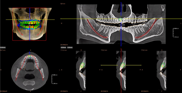 Automatic CT and IOS Overlay